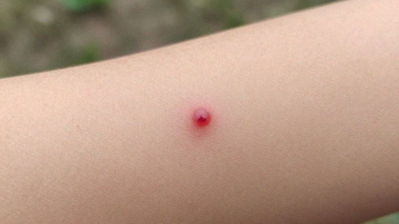 Jakie są objawy uczulenia na komary?