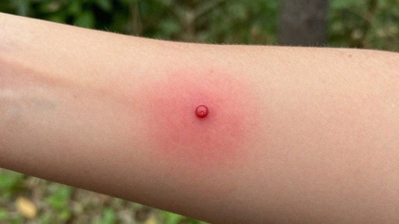 Jak rozpoznać reakcję alergiczną po ugryzieniu meszki?