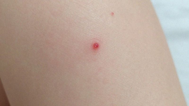 Kiedy i jakie są objawy ospy wietrznej?