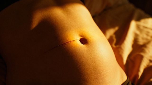 Jak bolą zrosty po cesarce? Objawy, diagnostyka i leczenie