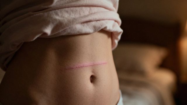 Zrosty po cesarce — objawy, diagnostyka i jak je leczyć?
